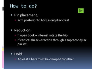 How to do? 
 Pin placement: 
 2cm posterior to ASIS along iliac crest 
 Reduction: 
 If open book – internal rotate the hip 
 If vertical shear – traction through a supracondylar 
pin 1st 
 Hold: 
 At least 2 bars must be clamped together 
 