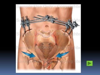 Pelvic injuries trauma 2012