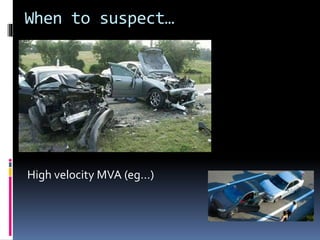 When to suspect… 
High velocity MVA (eg…) 
 