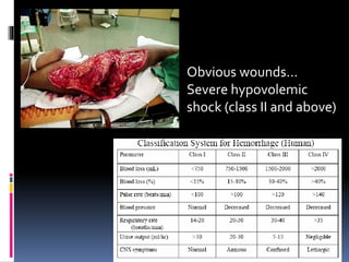 Obvious wounds… 
Severe hypovolemic 
shock (class II and above) 
 