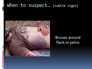 When to suspect… (subtle signs) 
Bruises around 
flank or pelvis 
 
