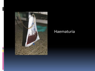 Haematuria 
 