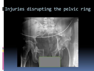Injuries disrupting the pelvic ring 
 