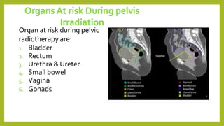 Organ at risk during pelvic
radiotherapy are:
1. Bladder
2. Rectum
3. Urethra & Ureter
4. Small bowel
5. Vagina
6. Gonads
 