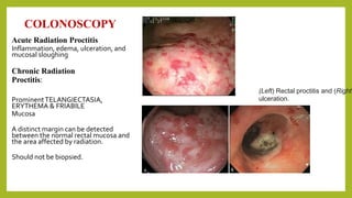 COLONOSCOPY
Acute Radiation Proctitis
Inflammation, edema, ulceration, and
mucosal sloughing
Chronic Radiation
Proctitis:
ProminentTELANGIECTASIA,
ERYTHEMA & FRIABILE
Mucosa
A distinct margin can be detected
between the normal rectal mucosa and
the area affected by radiation.
Should not be biopsied.
(Left) Rectal proctitis and (Right)
ulceration.
 