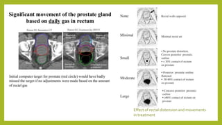 Effect of rectal distension and movements
in treatment
 