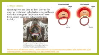 2. Rectal spacers:
Rectal spacers are used to limit dose to the
anterior rectal wall in high dose external beam
radiation therapy of the prostate and have
been shown to reduce radiation induced
toxicity.
Rectum-spacer related acute toxicity – endoscopy results of 403 prostate cancer patients after implantation of gel
or balloon spacers | Radiation Oncology | FullText (biomedcentral.com)
 