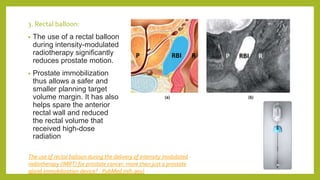3. Rectal balloon:
• The use of a rectal balloon
during intensity-modulated
radiotherapy significantly
reduces prostate motion.
• Prostate immobilization
thus allows a safer and
smaller planning target
volume margin. It has also
helps spare the anterior
rectal wall and reduced
the rectal volume that
received high-dose
radiation
The use of rectal balloon during the delivery of intensity modulated
radiotherapy (IMRT) for prostate cancer: more than just a prostate
gland immobilization device? - PubMed (nih.gov)
 