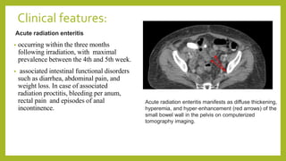 Clinical features:
Acute radiation enteritis
• occurring within the three months
following irradiation, with maximal
prevalence between the 4th and 5th week.
• associated intestinal functional disorders
such as diarrhea, abdominal pain, and
weight loss. In case of associated
radiation proctitis, bleeding per anum,
rectal pain and episodes of anal
incontinence.
Acute radiation enteritis manifests as diffuse thickening,
hyperemia, and hyper‐enhancement (red arrows) of the
small bowel wall in the pelvis on computerized
tomography imaging.
 