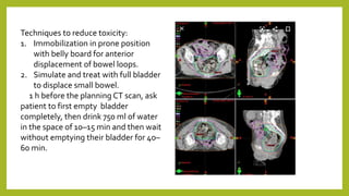 Techniques to reduce toxicity:
1. Immobilization in prone position
with belly board for anterior
displacement of bowel loops.
2. Simulate and treat with full bladder
to displace small bowel.
1 h before the planning CT scan, ask
patient to first empty bladder
completely, then drink 750 ml of water
in the space of 10–15 min and then wait
without emptying their bladder for 40–
60 min.
 