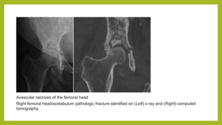 Avascular necrosis of the femoral head
Right femoral head/acetabulum pathologic fracture identified on (Left) x‐ray and (Right) computed
tomography.
 