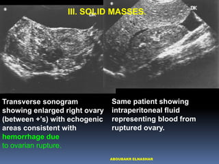 Sonographic Evaluation of Pelvic Masses | PDF