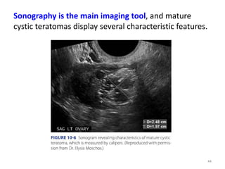 Sonography is the main imaging tool, and mature
cystic teratomas display several characteristic features.
44
 