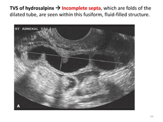 TVS of hydrosalpinx  Incomplete septa, which are folds of the
dilated tube, are seen within this fusiform, fluid-filled structure.
64
 