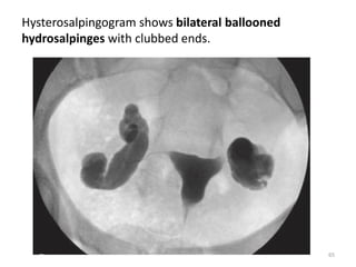 Hysterosalpingogram shows bilateral ballooned
hydrosalpinges with clubbed ends.
65
 