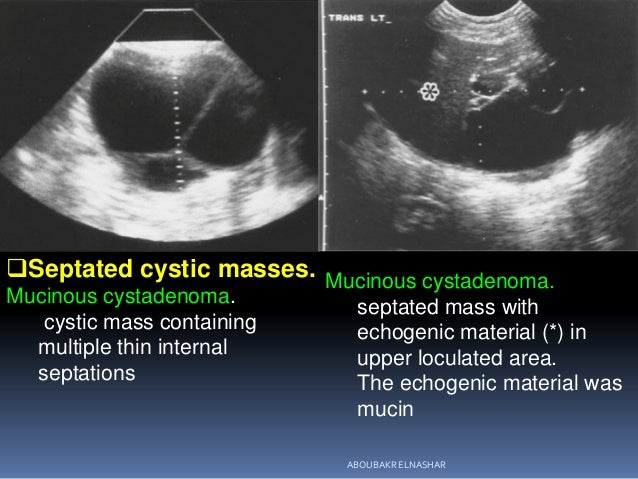 Gynaecology | 3.2 Adnexa : Case 3.2.1 Benign cystic ...