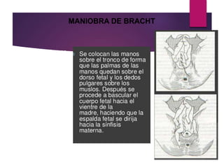 Consiste en tomar
al feto por ambos
pies y llevarlo hacia
arriba y atrás,
curvando su cuerpo
sobre el dorso y
acercando sus
extremidades
inferiores al
abdomen de la
madre
MANIOBRA DE BRACHT
 