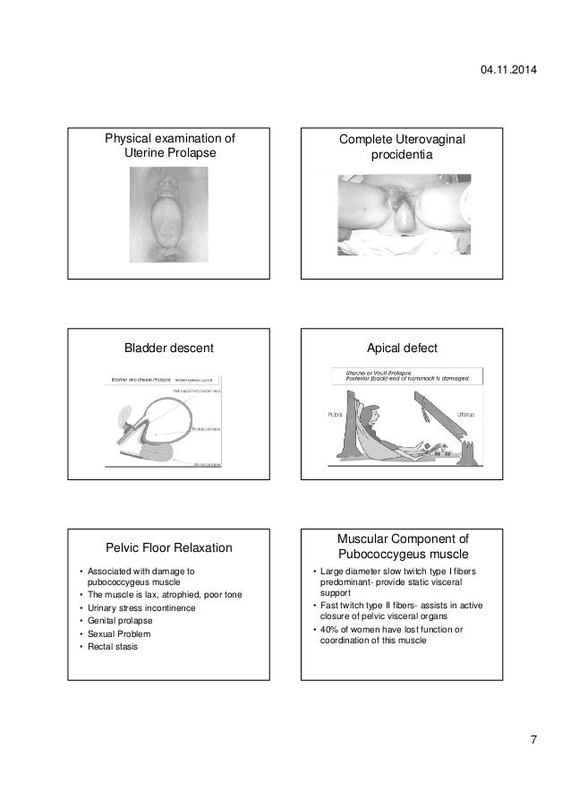 Pelvic organ prolapse Diagnosis and treatment