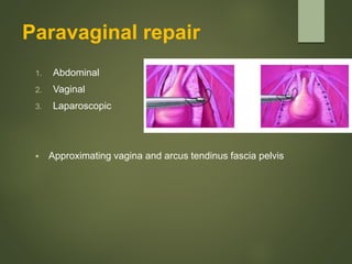 Paravaginal repair
1. Abdominal
2. Vaginal
3. Laparoscopic
 Approximating vagina and arcus tendinus fascia pelvis
 
