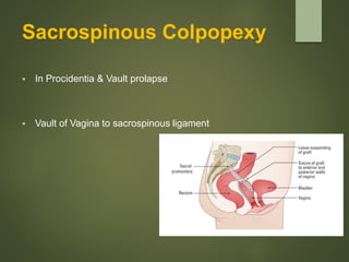 Sacrospinous Colpopexy
 In Procidentia & Vault prolapse
 Vault of Vagina to sacrospinous ligament
 
