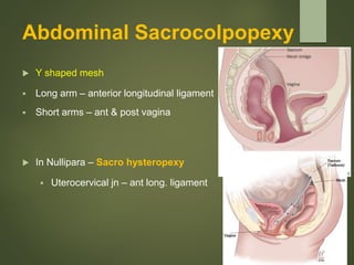 Abdominal Sacrocolpopexy
 Y shaped mesh
 Long arm – anterior longitudinal ligament
 Short arms – ant & post vagina
 In Nullipara – Sacro hysteropexy
 Uterocervical jn – ant long. ligament
 