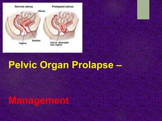 Pelvic Organ Prolapse –
Management
 
