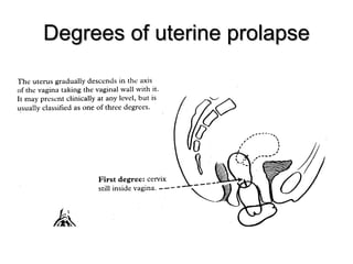Degrees of uterine prolapse-contd
 