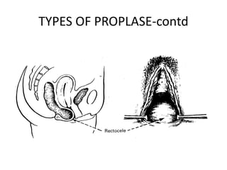 TYPES OF PROPLASE-contd
 