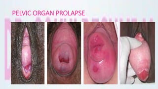 PELVIC ORGAN PROLAPSE
 