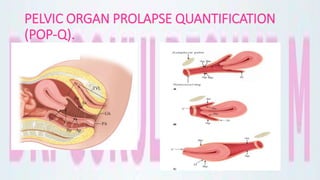 PELVIC ORGAN PROLAPSE QUANTIFICATION
(POP-Q).
 
