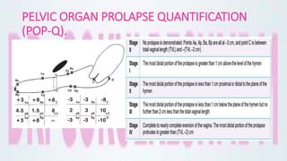 PELVIC ORGAN PROLAPSE QUANTIFICATION
(POP-Q).
 