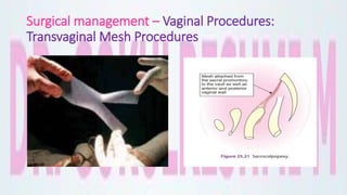 Surgical management – Vaginal Procedures:
Transvaginal Mesh Procedures
 