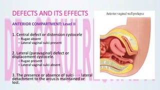 DEFECTS AND ITS EFFECTS
ANTERIOR COMPARTMENT: Level II
1. Central defect or distension cystocele
– Rugae absent
– Lateral vaginal sulci present
2. Lateral (paravaginal) defect or
displacement cystocele.
– Rugae present
– Lateral vaginal sulci absent
3. The presence or absence of sulci lateral
detachment to the arcus is maintained or
lost.
 