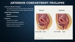 Pelvic organ prolapse in womens health physiotherapy | PPTX