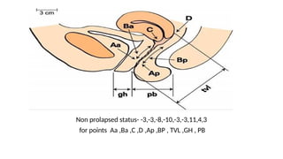 PELVIC ORGAN PROLAPSE final.pptx sssssssss | PPTX