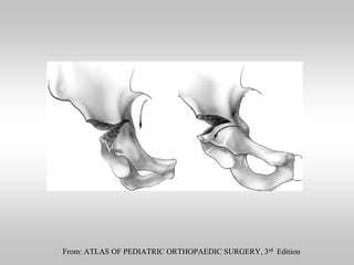 From: ATLAS OF PEDIATRIC ORTHOPAEDIC SURGERY, 3rd Edition

 