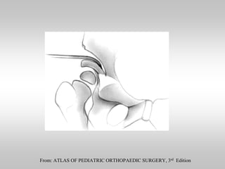 From: ATLAS OF PEDIATRIC ORTHOPAEDIC SURGERY, 3rd Edition

 
