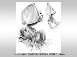 From: ATLAS OF PEDIATRIC ORTHOPAEDIC SURGERY, 3rd Edition

 