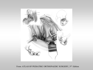 From: ATLAS OF PEDIATRIC ORTHOPAEDIC SURGERY, 3rd Edition

 