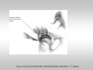 From: ATLAS OF PEDIATRIC ORTHOPAEDIC SURGERY, 3rd Edition

 