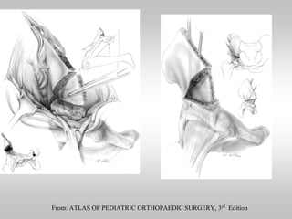 From: ATLAS OF PEDIATRIC ORTHOPAEDIC SURGERY, 3rd Edition

 