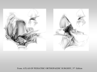 From: ATLAS OF PEDIATRIC ORTHOPAEDIC SURGERY, 3rd Edition

 