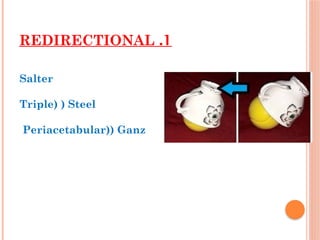 Pelvic Osteotomy-1.pptx 00000000000000000000000000000 | PPTX