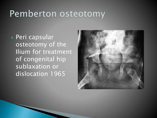 Peri capsular
osteotomy of the
Ilium for treatment
of congenital hip
sublaxation or
dislocation 1965