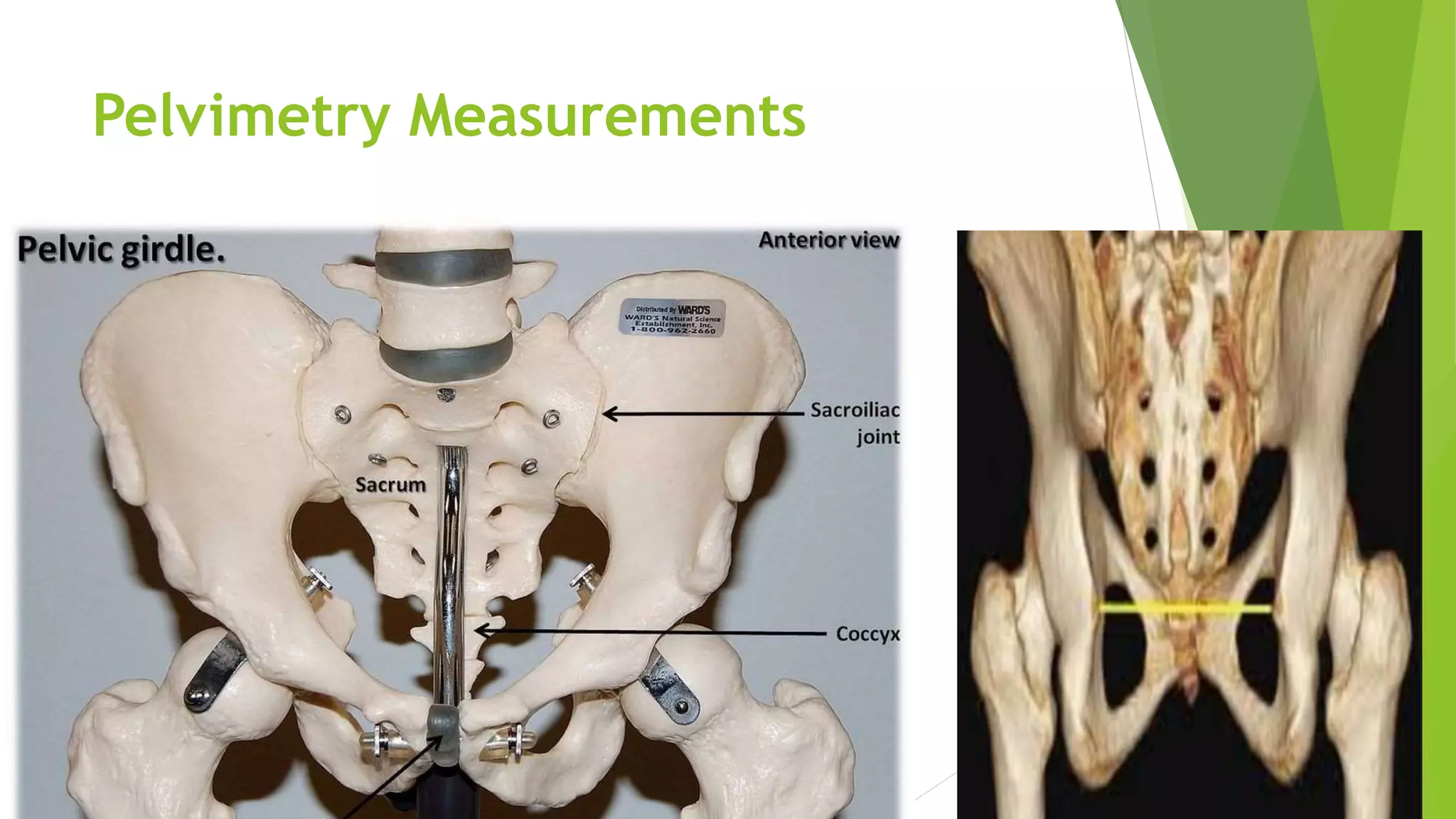 Pelvimetry | PPT