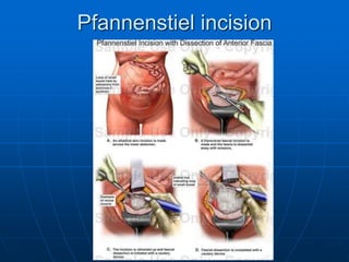 Pelvic ring for md1 | PPTX