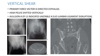 PELVIC RING FRACTURES | PPTX