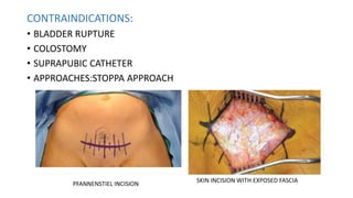 PELVIC RING FRACTURES | PPTX