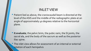 INLETVIEW
• Patient lied as above, the craniocaudal beam is directed at the
level of the ASIS and the middle of the radiographic plate at an
angle of approximately 40 degrees relative to the horizontal
plane.
• It evaluate; the pelvic brim, the pubic rami, the SI joints, the
sacral ala, and the body of the sacrum as well as the posterior
iliac spine.
• The inlet view allows for assessment of an internal or external
rotation of each hemipelvis
 