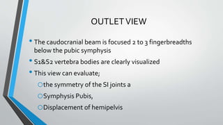 OUTLETVIEW
• The caudocranial beam is focused 2 to 3 fingerbreadths
below the pubic symphysis
• S1&S2 vertebra bodies are clearly visualized
• This view can evaluate;
othe symmetry of the SI joints a
oSymphysis Pubis,
oDisplacement of hemipelvis
 